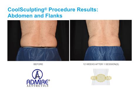 real coolsculpting results.